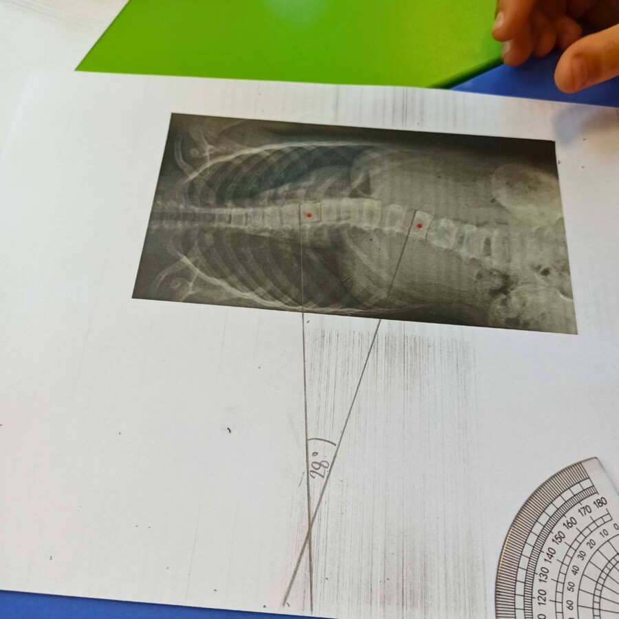 LEKCJA O SKOLIOZIE - MIERZENIE KĄTÓW