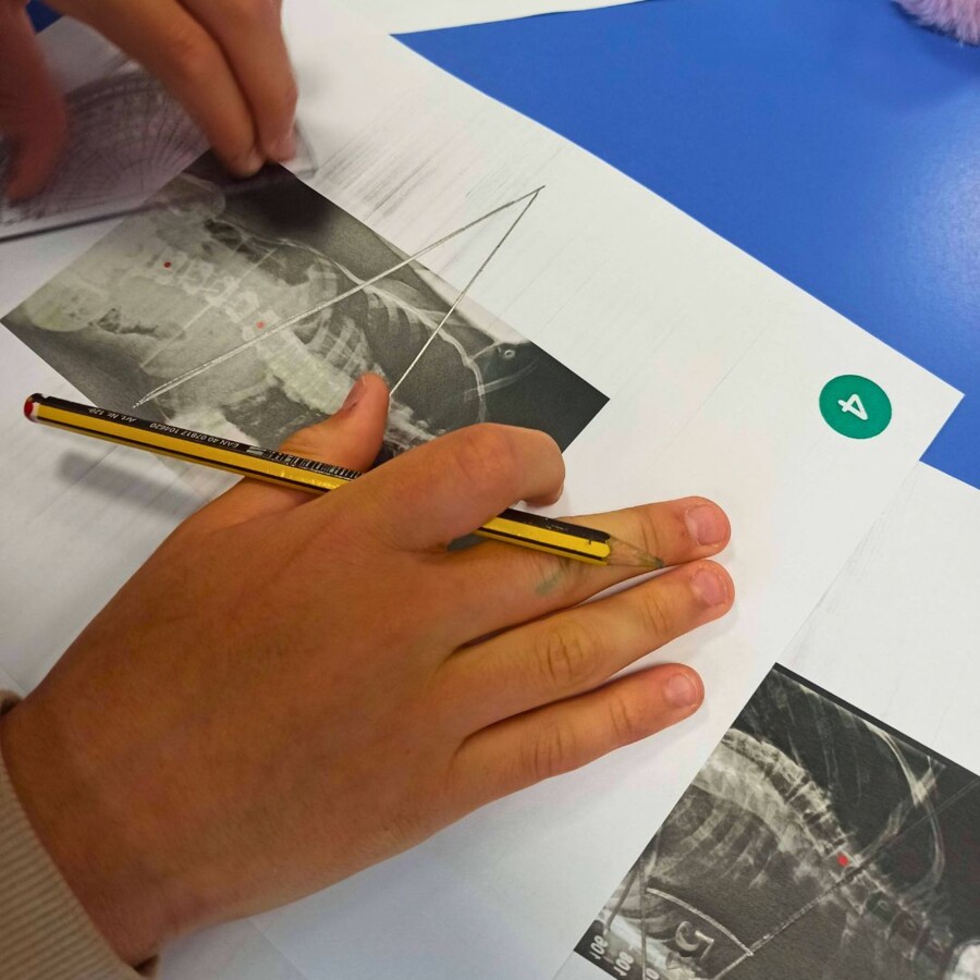 LEKCJA O SKOLIOZIE - MIERZENIE KĄTÓW