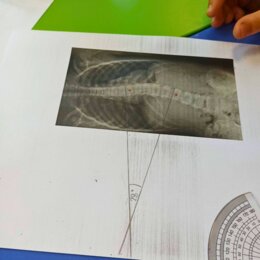 LEKCJA O SKOLIOZIE - MIERZENIE KĄTÓW