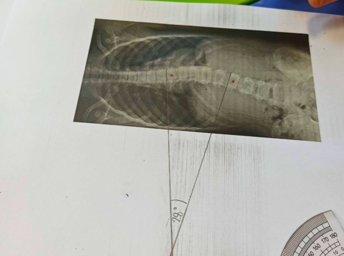 LEKCJA O SKOLIOZIE - MIERZENIE KĄTÓW